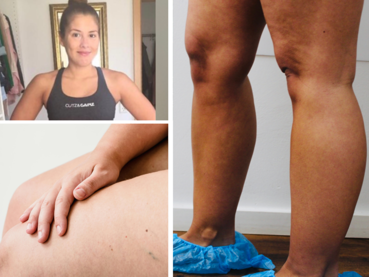 Collage-Lipödem-Betroffene Collage aus drei Bildern: sportliche Frau in Trainingskleidung, Hand auf einem Oberschenkel, Beine mit blauen Einwegüberziehern.