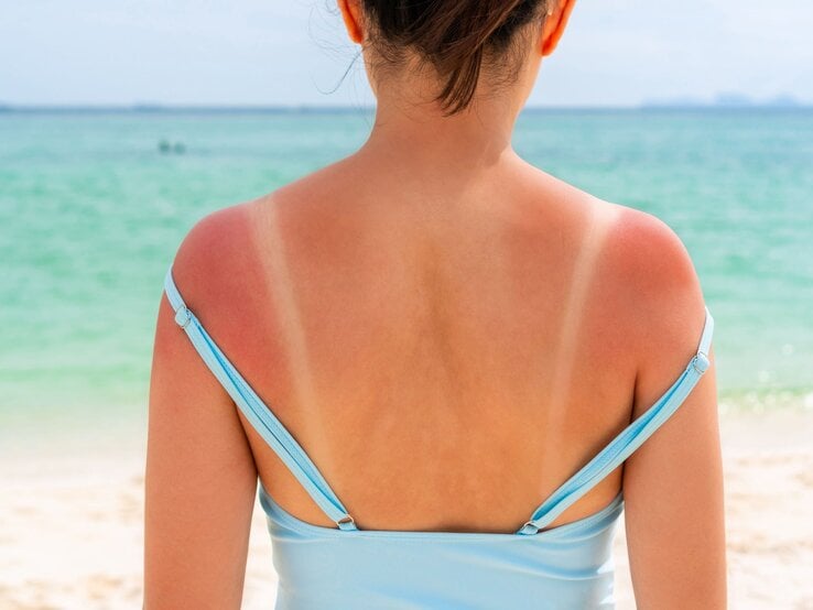 Frau mit roten Sonnenbrandstreifen auf den Schultern, in blauem Trägerkleid am Strand mit klarem Meerwasser und hellem Sand.