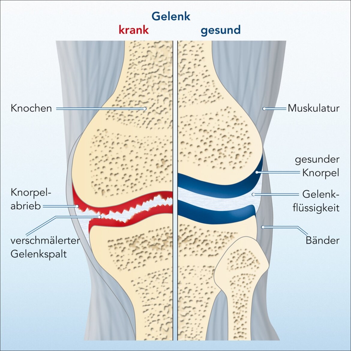 Vergleich einer kranken und gesunden Gelenkstruktur, links mit Knorpelabrieb und verengtem Gelenkspalt, rechts mit gesundem Knorpel. | © CH-Alpha Forschung