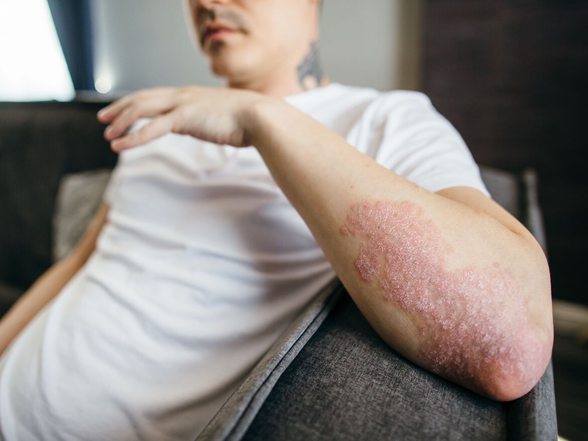 Ein junger Mann in weißem T-Shirt sitzt auf einem Sofa, sein Ellenbogen zeigt deutliche Anzeichen von Psoriasis auf geröteter Haut. | © GettyImages/Tanja Ivanova